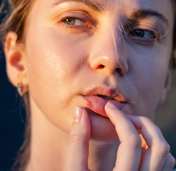 Cold or Canker Sores