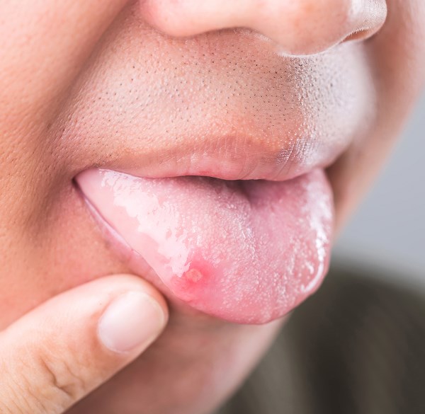 Cut or Bitten Tongue, Lip or Cheek